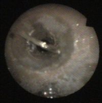 endoscope image of blocked needle valve